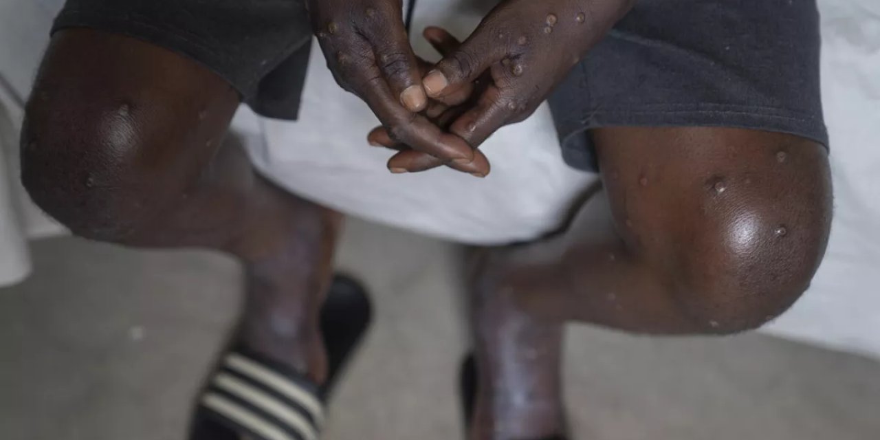 Maymun Çiçeği hastalığı bebeklerde de görülmeye başladı!