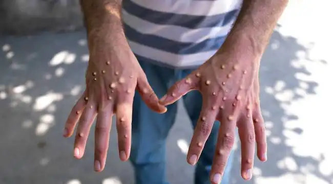 Sağlık Bakanlığı Maymun Çiçeği hakkında merak edilenleri yanıtladı: Nasıl bulaşır, ne yapmalı?