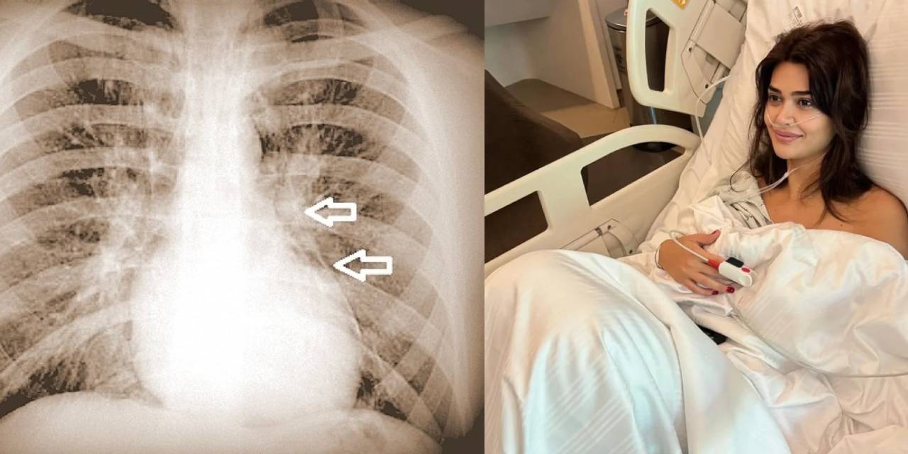Elektronik sigara oyuncu Selen Görgüzel'in kızını öldürüyordu: Peki Pnömomediastinum nedir? Nasıl belirti verir?