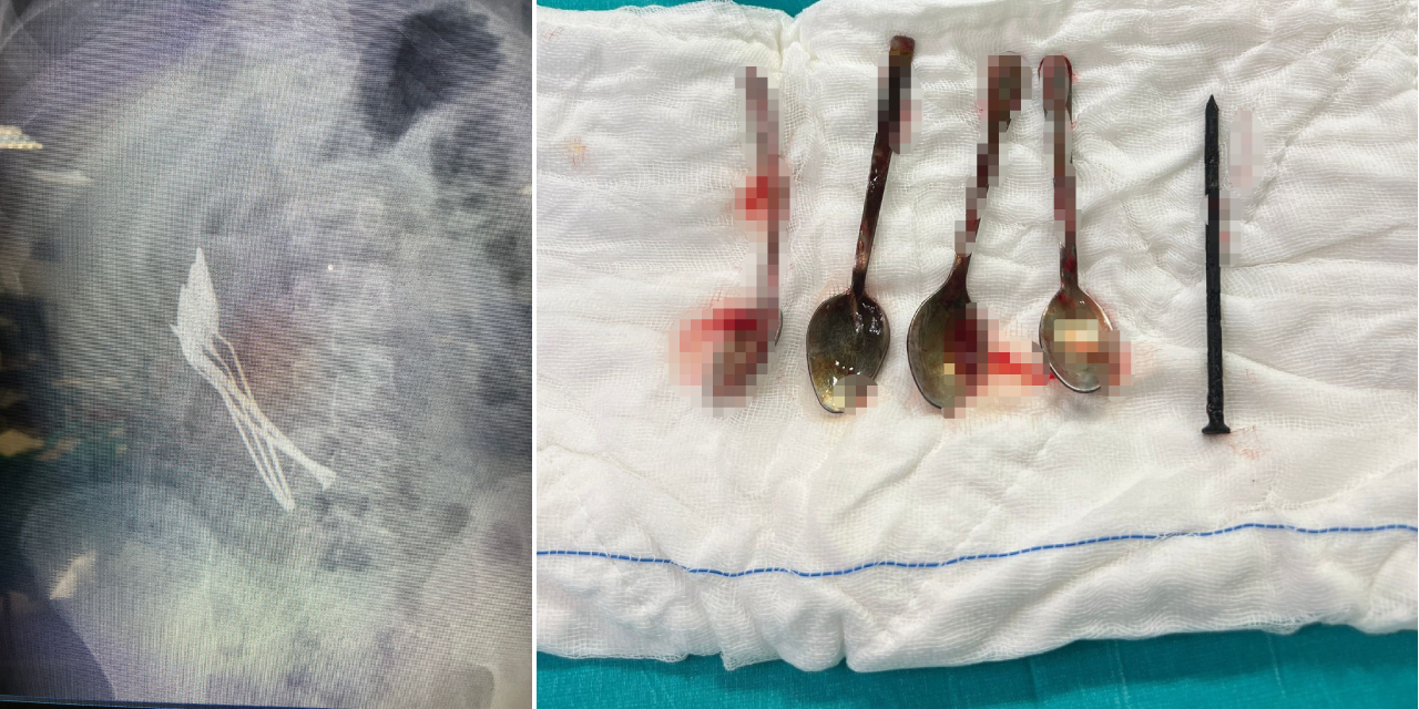 Kayseri'de şaşırtan olay: Çocuğun midesinde 4 metal kaşık ve 1 çivi çıkarıldı