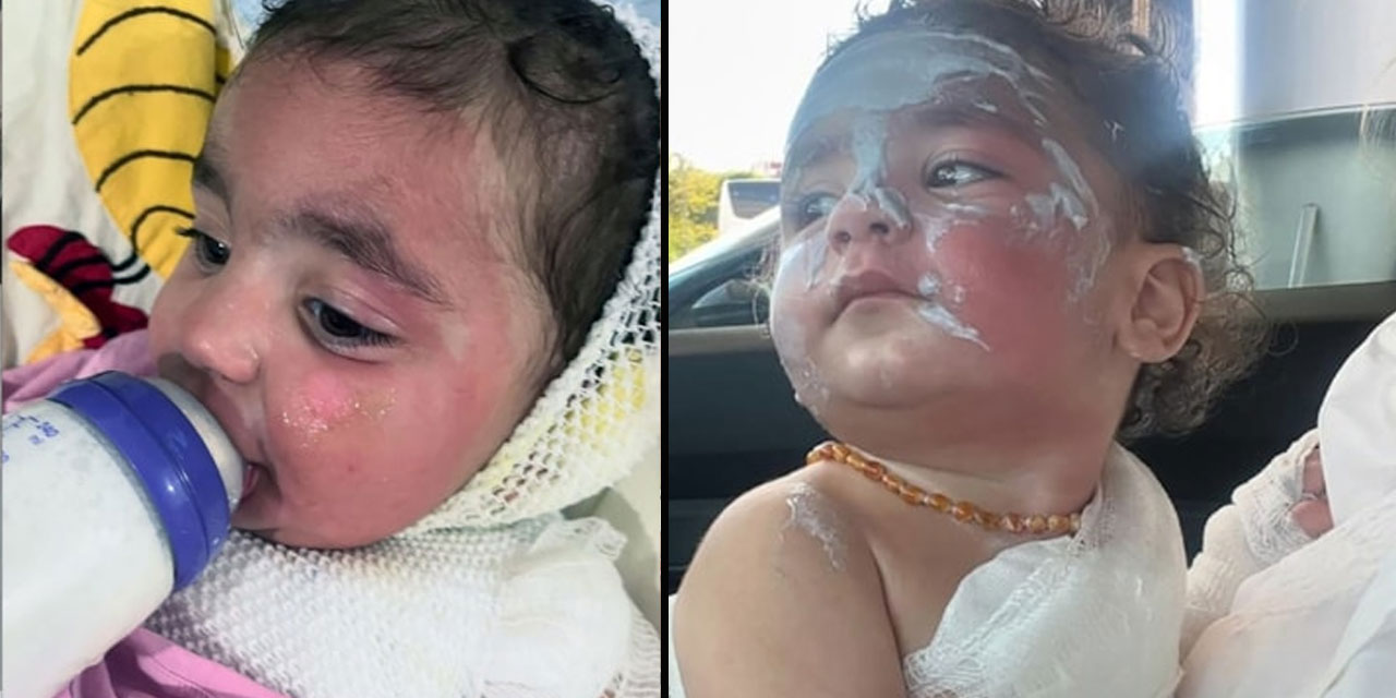 Kreşte kahve faciası: Aden bebeğin yüzü ve vücudu yandı