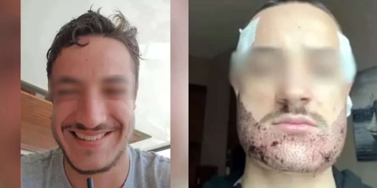 Sakal ektirmek için Türkiye'ye gelen genç Fransız intihar etti: Operasyonu emlakçı yapmış