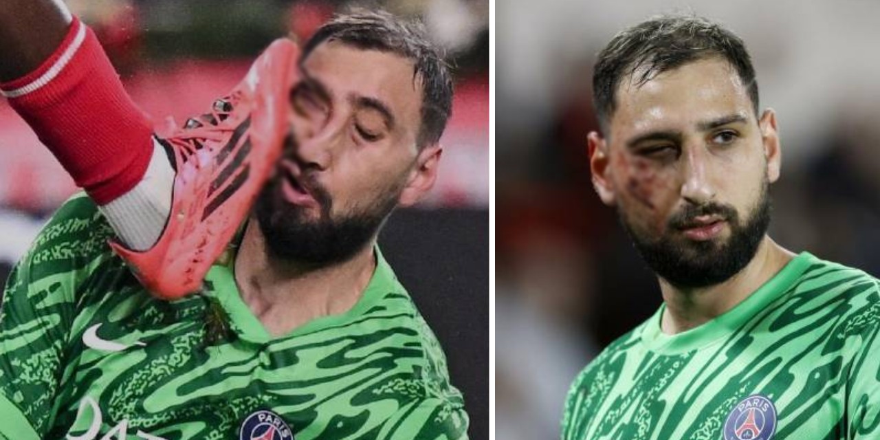 Monaco-PSG maçında Donnarumma'nın yüzü parçalandı