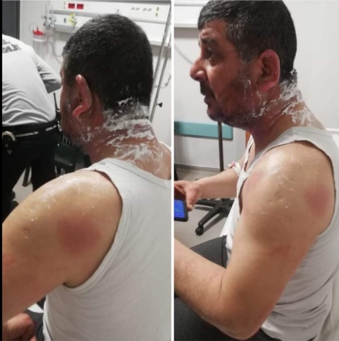 MHP'li adayın akrabası, DP Belediye Meclis Üyesi Adayı Oğuzhan Lök'e asitle saldırdı