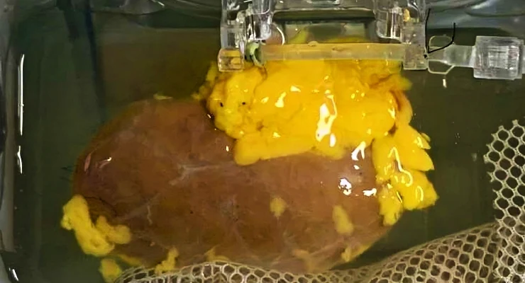 Kan grubuna bakılmaksızın nakledilebilecek "Evrensel böbrek" üretildi