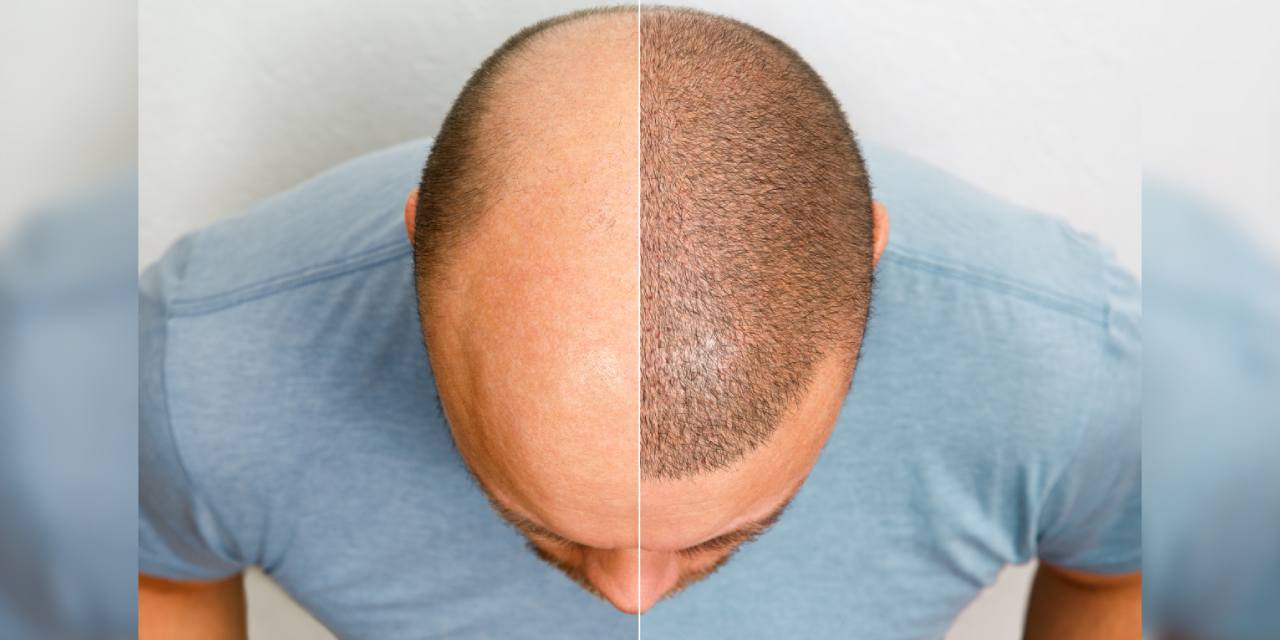 Sahte hekim skandalı: Turistlere saç ekiyordu!