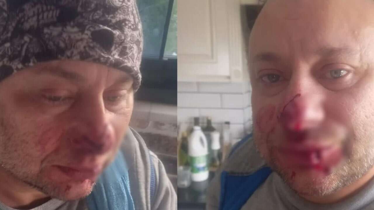 Onur Akay’ın pitbull saldırısında burnu koptu