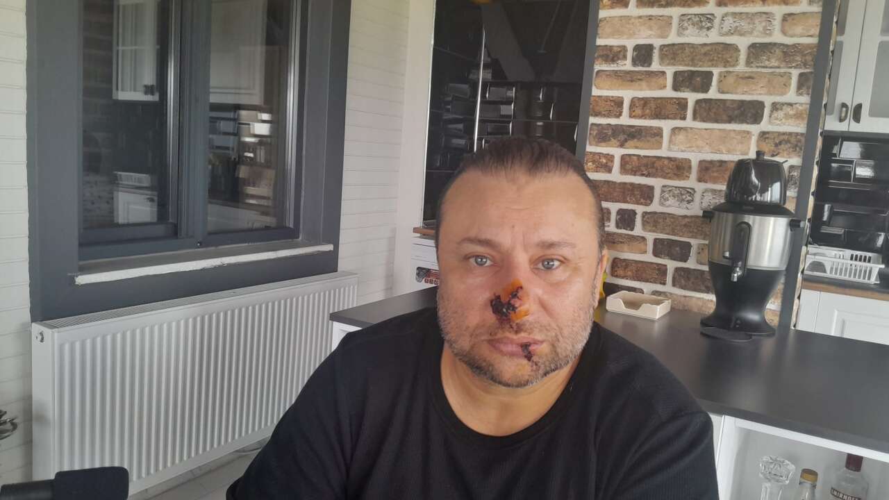 Onur Akay entübe edildi: “Et yiyen bakteri” şüphesi