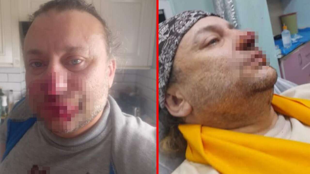 Burnunu Pitbull ısırmıştı: Şarkıcı Onur Akay et yiyen bakteri ile mücadele ediyor