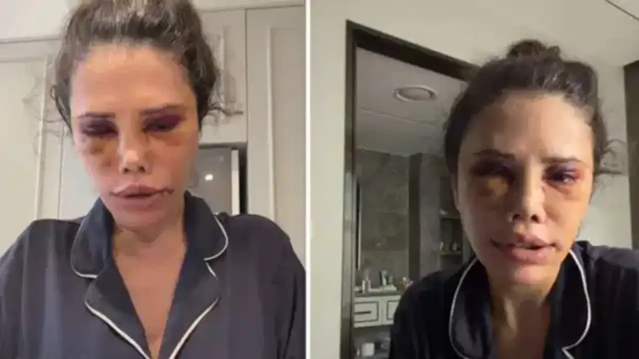 Survivor yarışmacısı Didem Ceran Güney Kore'deki estetik ameliyatını anlattı