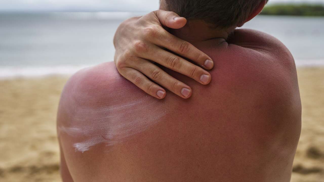 Tatil bitti kabus geldi: "Cehennem Kaşıntısı"nı hafife almayın