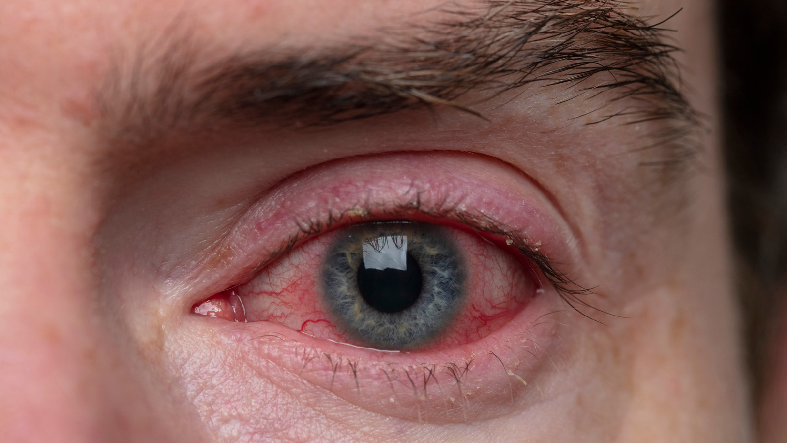 Behçet hastalığı nedir? Behçet hastalığının belirtileri nelerdir?