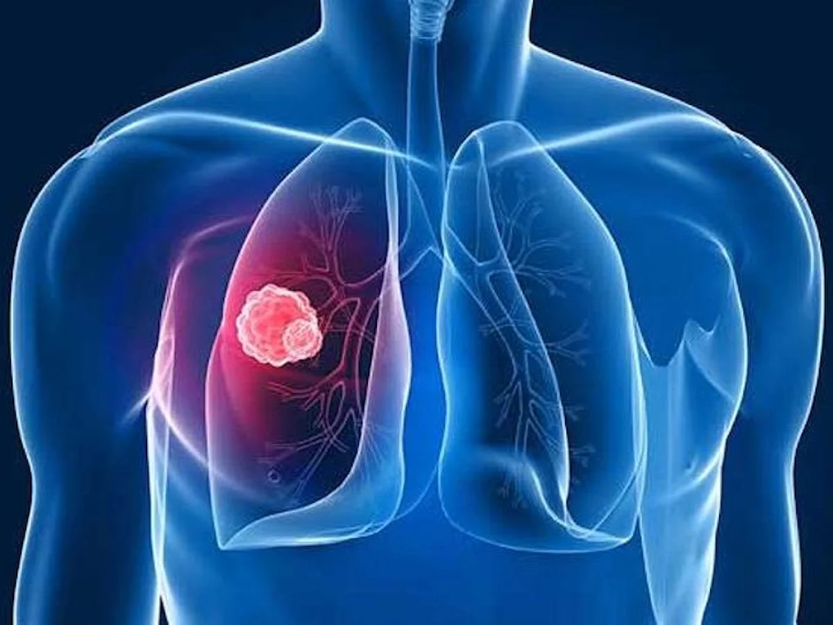 Akciğer kanserinin 10 önemli belirtisi