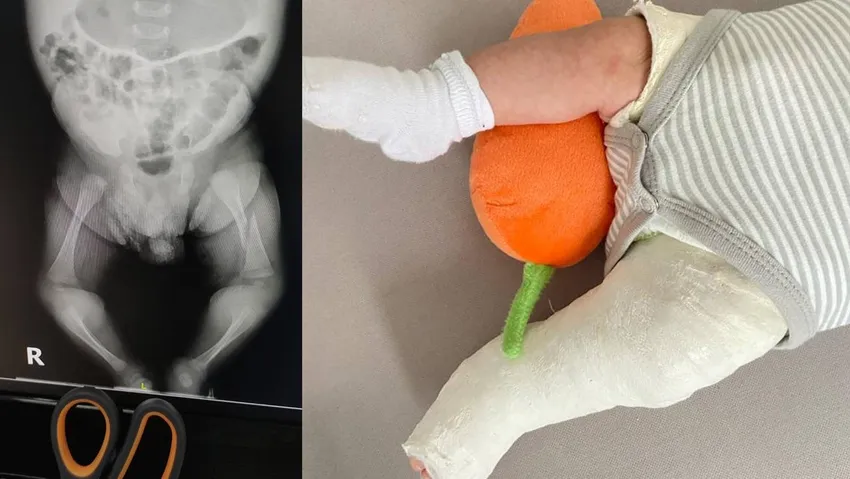 Eski AKP'li vekilin hastanesinde bir aylık bebeğin bacağı kırıldı