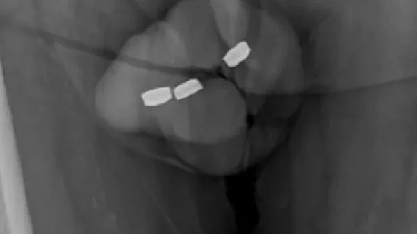 73 yaşındaki erkek mastürbasyon yaparken hastanelik oldu