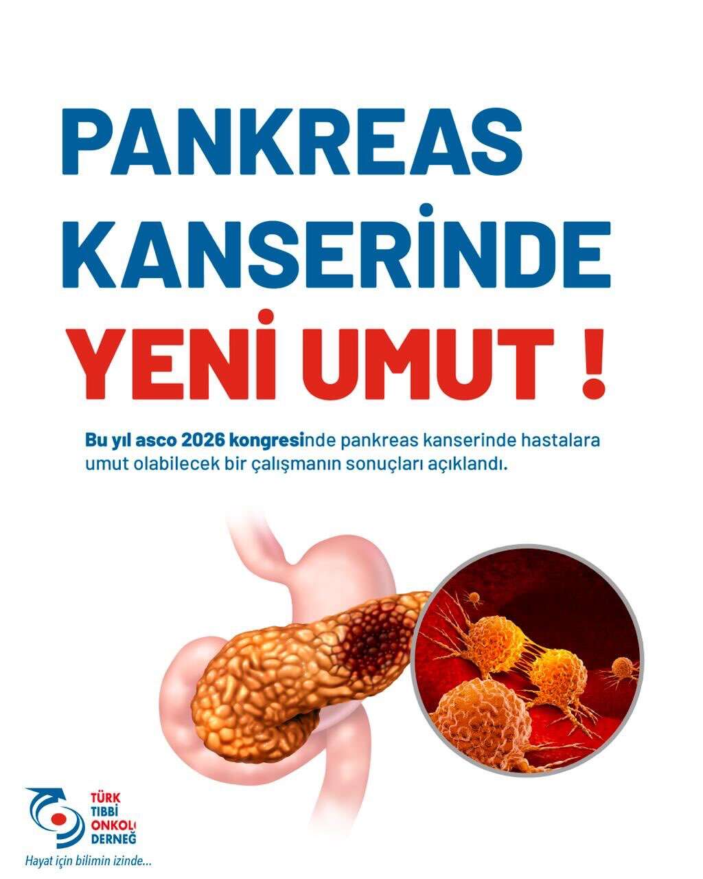 asco2026-pankreas-kanseri-gorsel-114059163